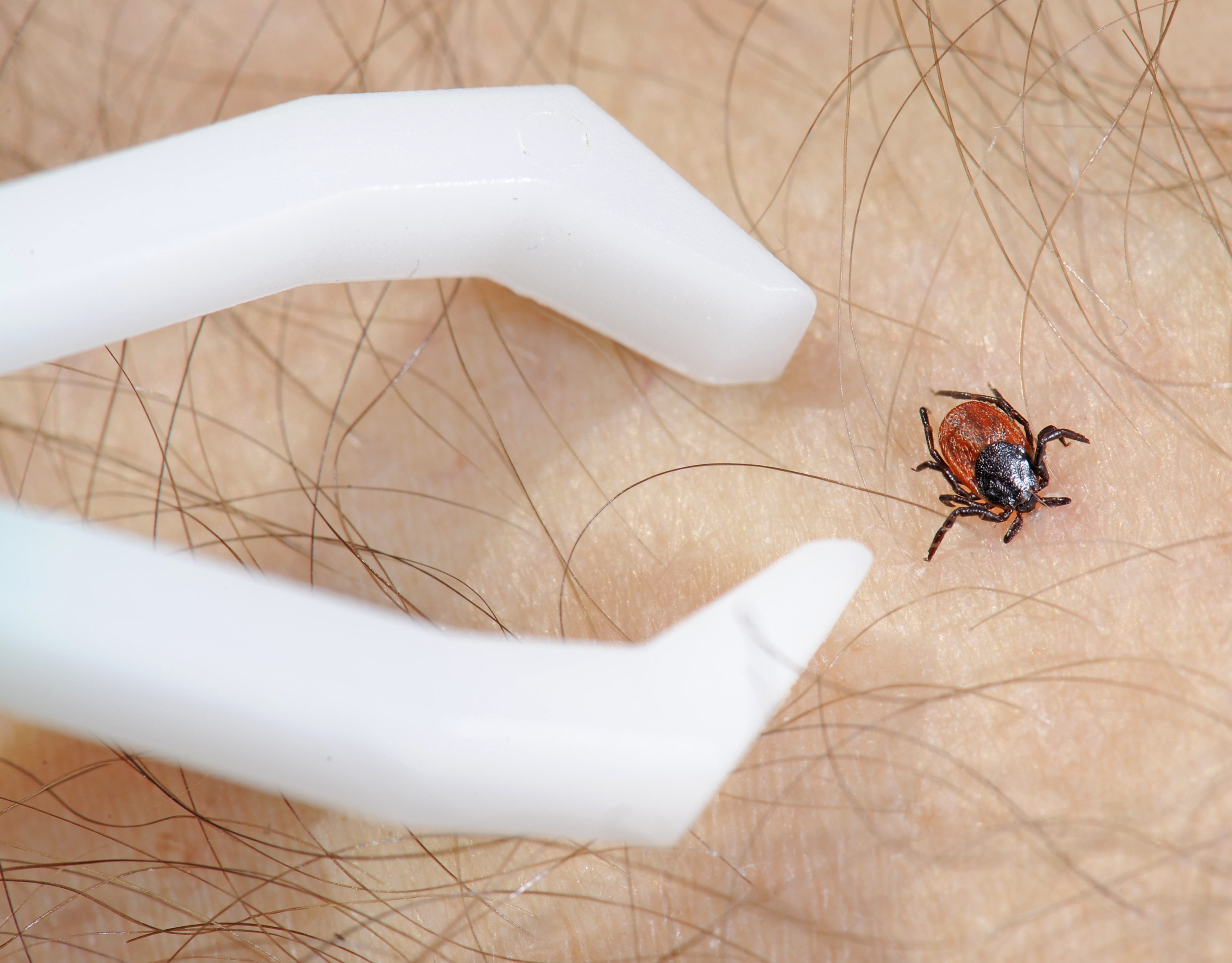 NJ kids join national research trial for new Lyme disease vaccine
