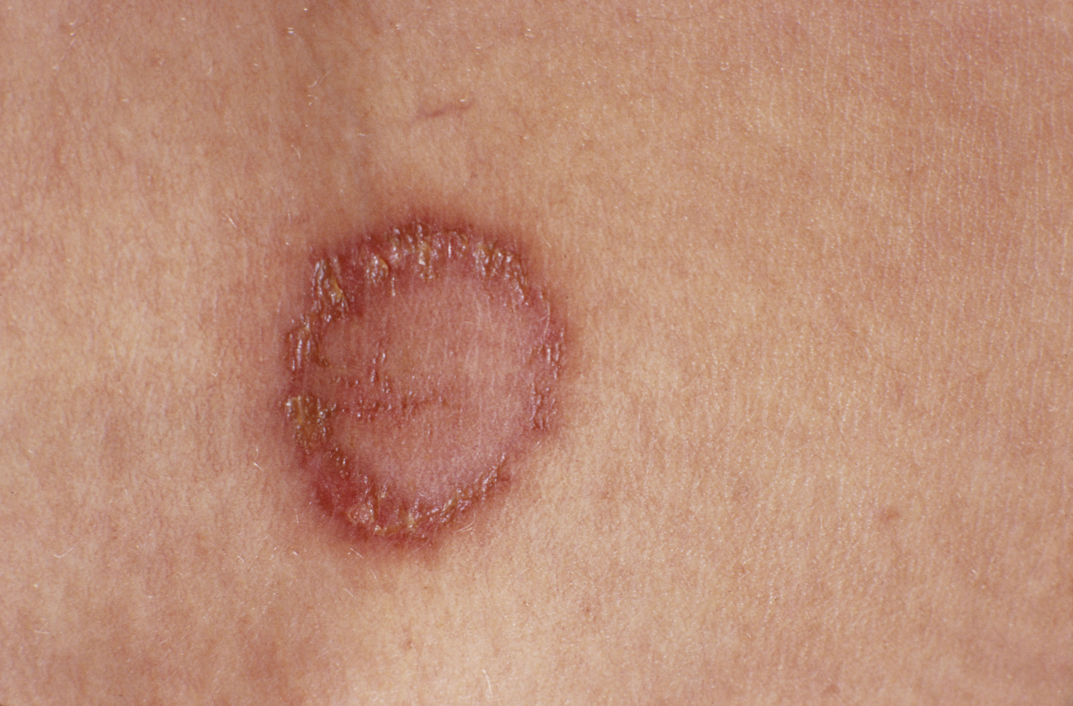 Psoriasis vs. Ringworm: What's the Difference? | MyPsoriasisTeam