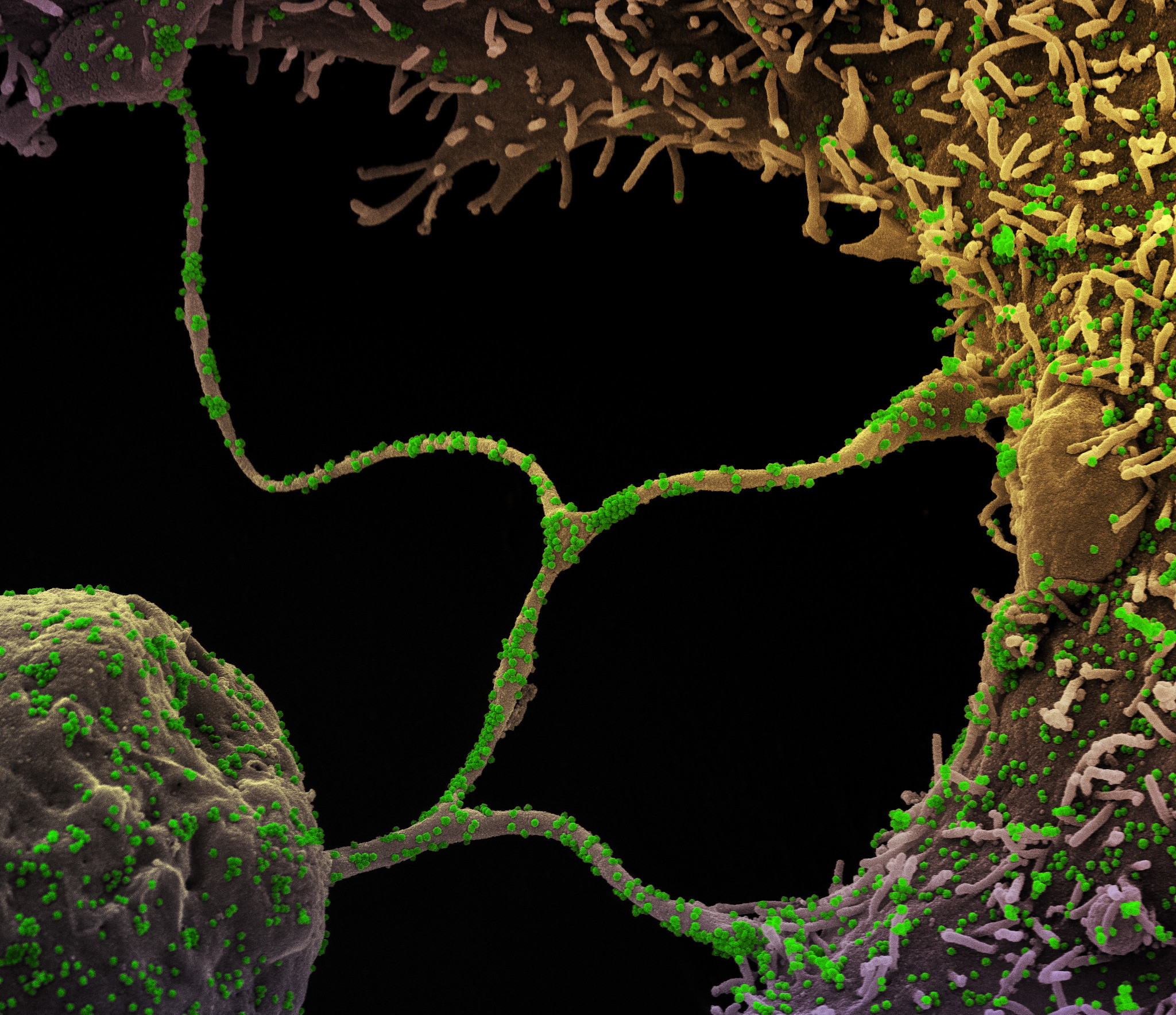 COVID-19 Variant 'Eris' Still Dominates, But Hospitalizations Slowing