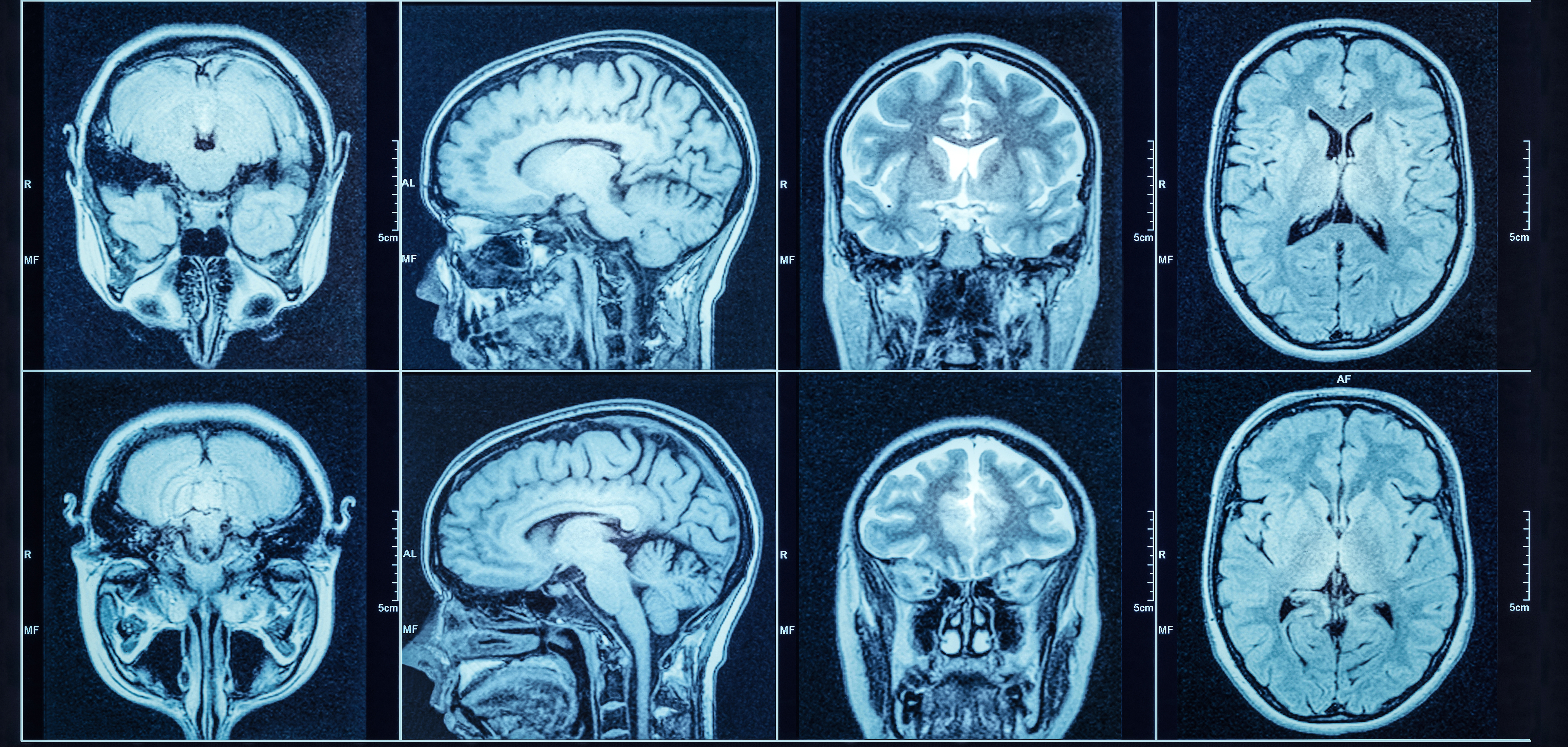 Close up of a MRI scan of a brain